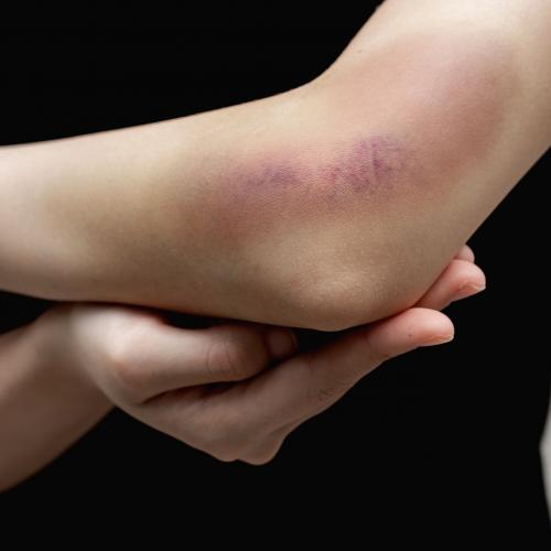 Первая помощь при ушибах и гематомах 07 Первая помощь при ушибах и гематомах 07