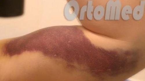 Первая помощь при ушибах и гематомах 04 Первая помощь при ушибах и гематомах 04